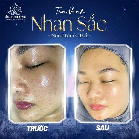 Chỉ 999k  liệu trình xoá nám công nghệ cao trong 30 ngày 6857361