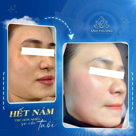 Chỉ 999k  liệu trình xoá nám công nghệ cao trong 30 ngày 6857364