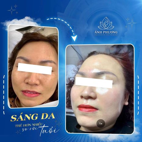 Chỉ 999k  liệu trình xoá nám công nghệ cao trong 30 ngày 6857367